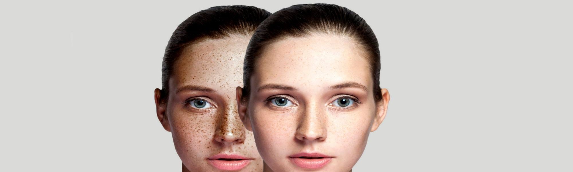 Пигментные пятна на лице причины и лечение